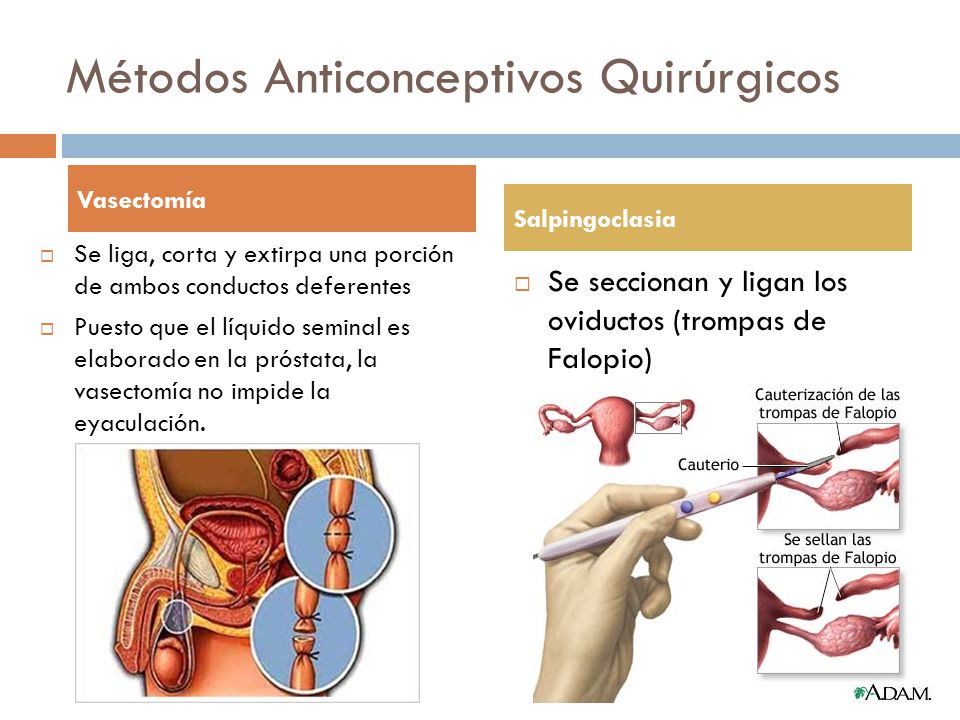 ventajas y desventajas de vasectomia y salpingoclasia